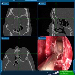 Frontal Sinus Surgery - Raleigh Capitol Sinus & Allergy Center