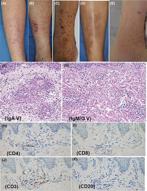 Clinical and pathological differences between skin‐limited IgM/IgG ...