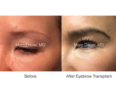 Eyebrow Restoration Los Angeles, Eyebrow Transplant Procedure