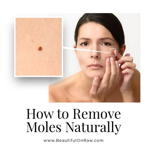 Skin Moles … Removal and Prevention | Beautiful On Raw