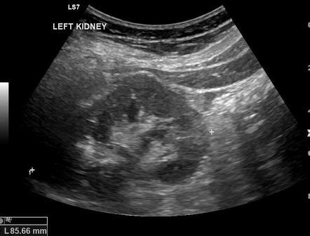 Vesicoureteric junction calculus | Image | Radiopaedia.org