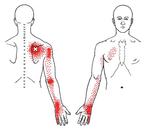 Serratus Posterior Superior | The Trigger Point & Referred Pain Guide