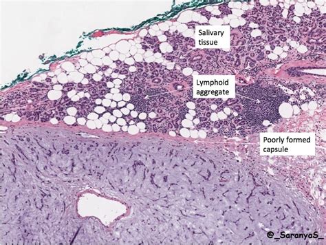 Pleomorphic Adenoma Pathology