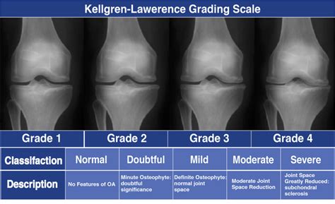 Osteoarthritis Stages Knee