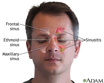 Sinus Infection (Sinusitis) - Symptoms and Causes | Penn Medicine