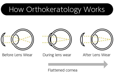 How Does Orthokeratology Work? | Specialty Eye