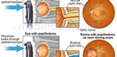 Papilledema