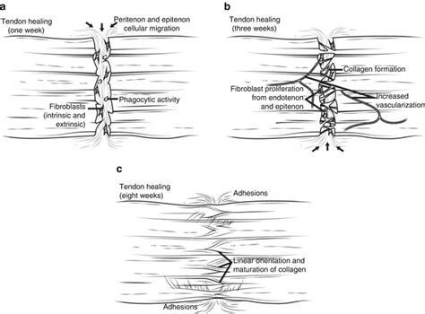 Tendon Healing | SpringerLink