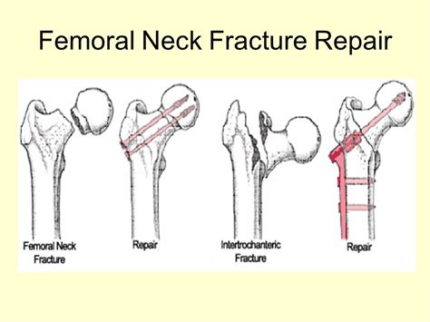 Femoral Neck Fracture: Causes, Symptoms & Treatments | Global Treatment ...