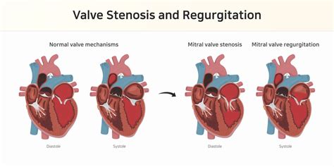 Valvular Heart Disease: What are the different types - Pulse Cardiology