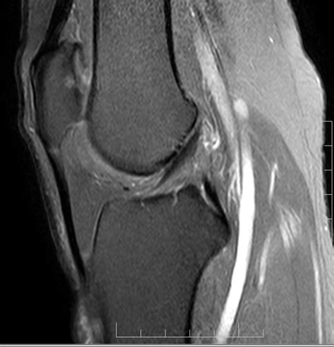 Chondromalacia Patellae-MRI - Sumer's Radiology Blog