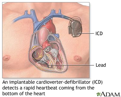 Implantable cardioverter-defibrillator: MedlinePlus Medical Encyclopedia