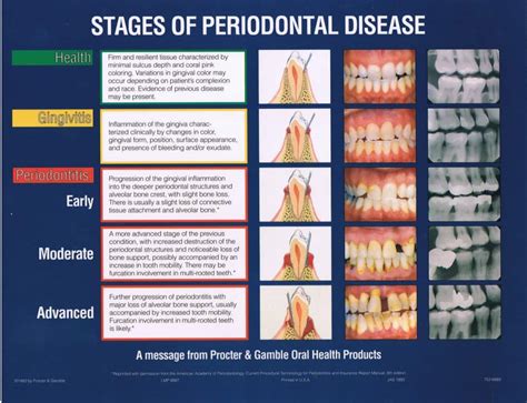 How To Prevent Periodontal Disease | Community Care College