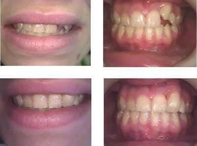 Bonding gaps between teeth with high end composite resins.