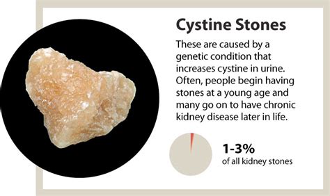 Kidney stones, a marker of overall kidney health - Heersink School of ...