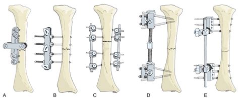 Principles and Complications of External Skeletal Fixation ...