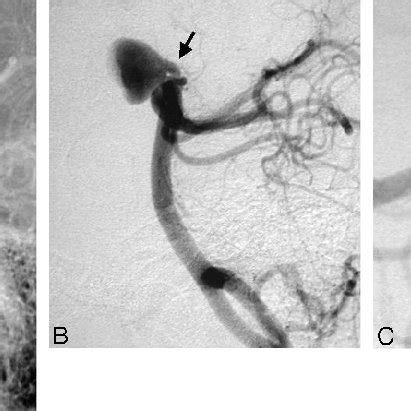 Posterior circulation angiogram shows an anteriorly pointing ...