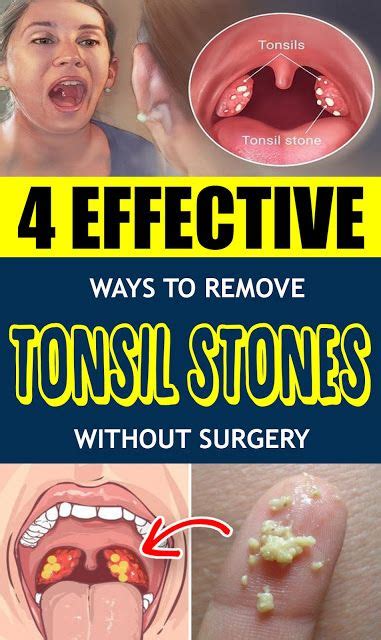 4 Effective Ways To Remove Tonsil Stones Without Surgery | Healthy Lands