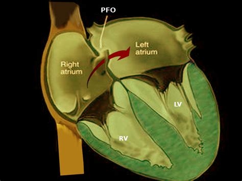 Catheter Management of Patent Foramen Ovale | Treatment & Management ...