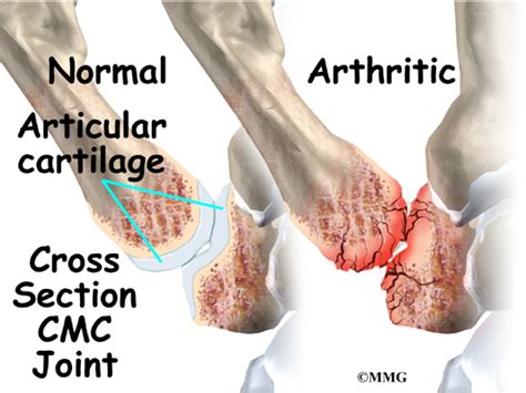 Artificial Joint Replacement of the Thumb - eOrthopod.com