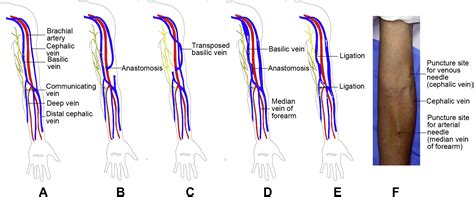 A modified nontransposed brachiobasilic arteriovenous fistula versus ...