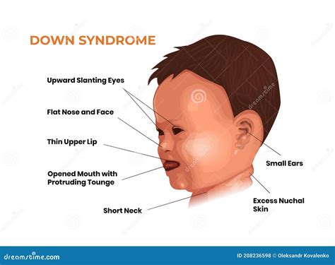 Face Features Of The Baby With Down Syndrome. Trisomy 21 Symptoms ...