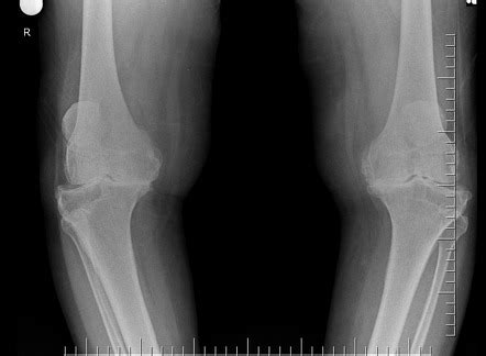 Kellgren and Lawrence system for classification of osteoarthritis ...