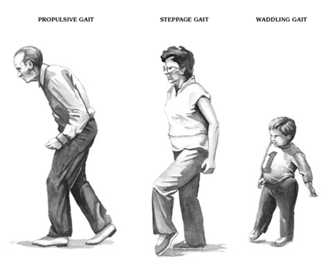 Symptom finder - The causes of gait abnormalities - Medical Zone