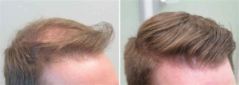 Finasteride Before and After Photos [2024]