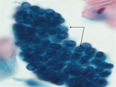 What Is An "Abnormal" Pap Smear?