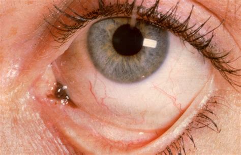 Study Shows Long-Term Outcomes of Conjunctival Melanoma - Ophthalmology ...