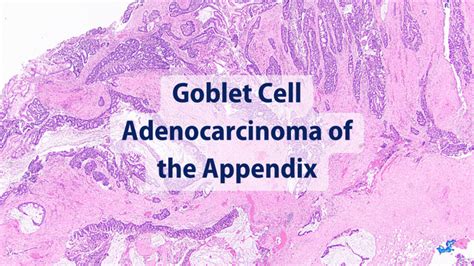 How are goblet cell adenocarcinomas treated?