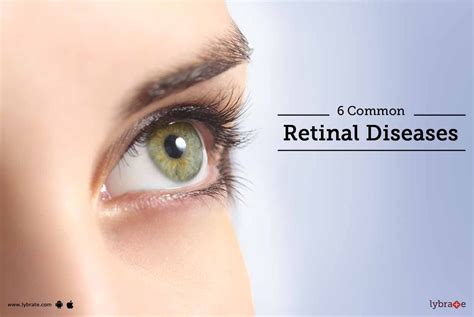 6 Common Retinal Diseases - By Dr. Tejas D. Shah | Lybrate