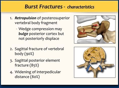 Ao Classification Burst Fracture