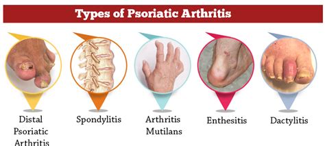 Psoriatic Arthritis Treatment