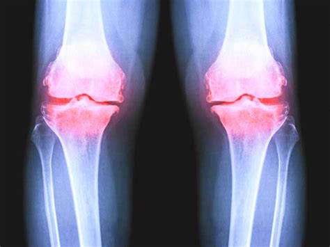 Osteoarthritis of the Knee X-Ray