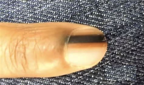 Si vous voyez cette ligne noire sur votre ongle, voici ce que cela ...