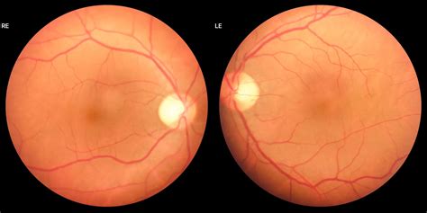 Fundus Photography Test for Retina & Nerve | Eye Solutions