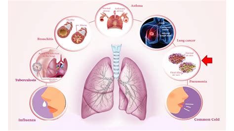 Respiratory Diseases