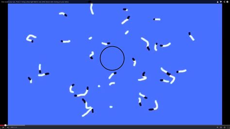 Visual snow (snowy Vision); a disease resulting from two different ...