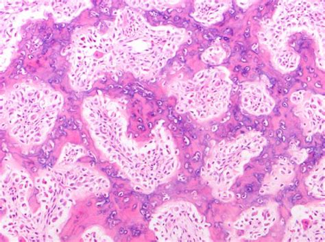 Osteoid Osteoma Histology