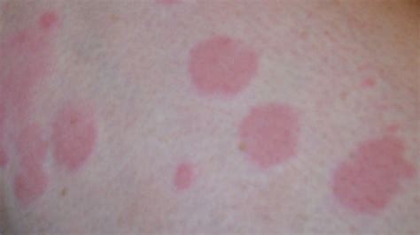 Urticaria Face