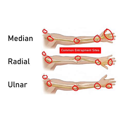 How To Fix Ulnar Nerve Entrapment | Causes & Symptoms | Gymless