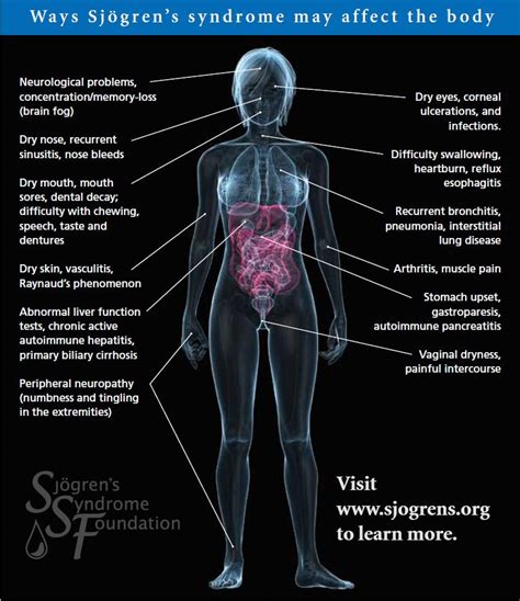 Symptoms of Sjogren's