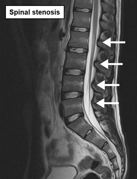 Spinal Canal Stenosis Mri - img-gimcrackery