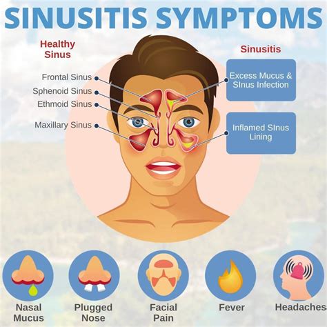 Frontal Sinus Headache