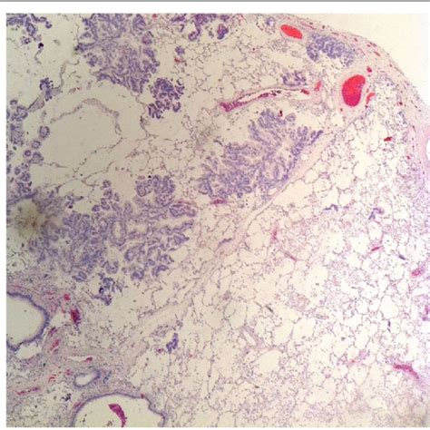 Tissue histology revealed mucinous adenocarcinoma of the lung whose ...