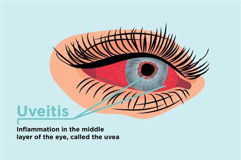 Uveitis - HarrisLlorenna