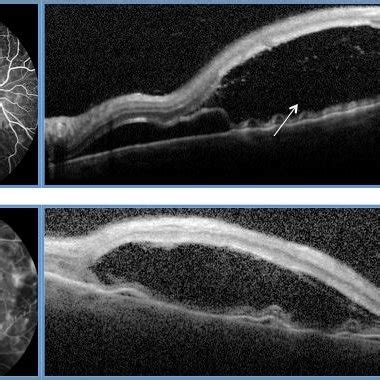 SD-OCT showing a large serous retinal detachment (SRD) at the level of ...