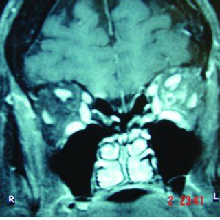 MRI scan depicting characteristic and rare Optic perineuritis resulting ...